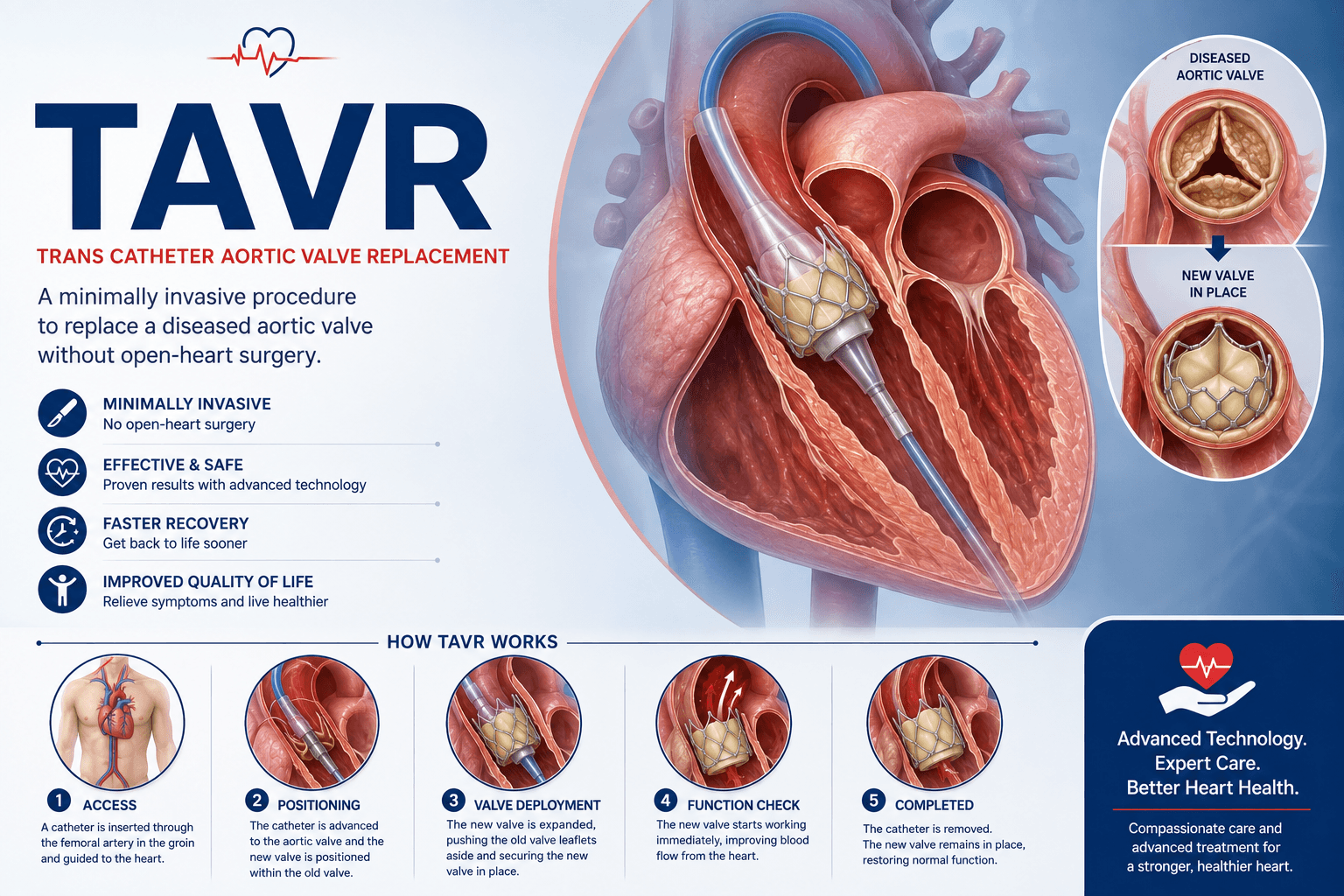 TAVR