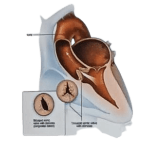 Heart valve disease assessment and treatment